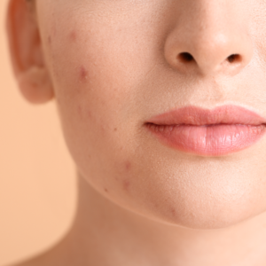 Acne and Blemishes