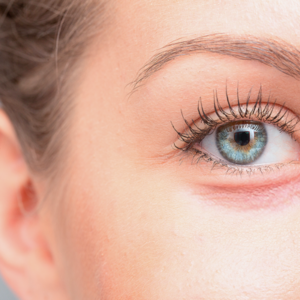 Dark Under-Eye Circles