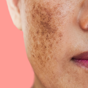 Hyperpigmentation, Dark Spots and Melasma