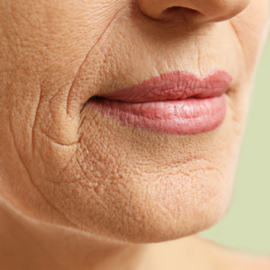 Wrinkles
